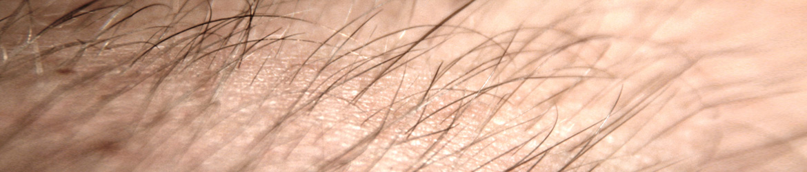 body-hair-transplantation