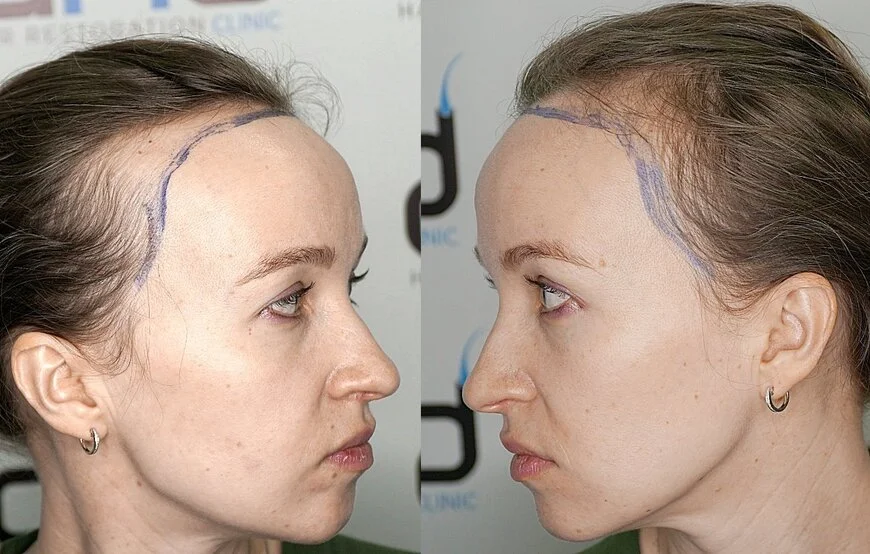 womens hair transplant