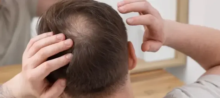 пересадка_волос-на_макушку