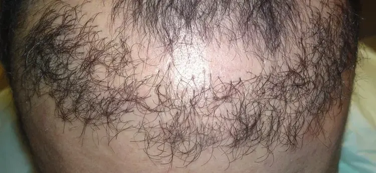 اسباب فشل عمليات زراعة الشعر في تركيا
