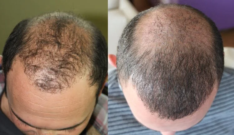 Eine gescheiterte Haartransplantation-Operation und ihr korrigiertes Bild