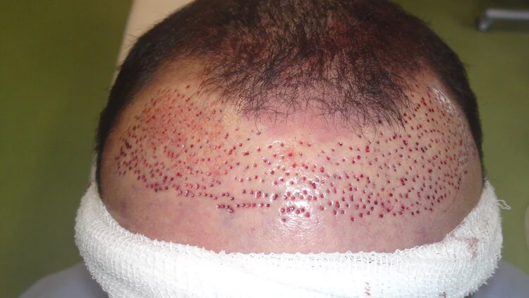 Zur Korrektur der fehlgeschlagenen Haartransplantation wurden die defekten Haartransplantate entfernt