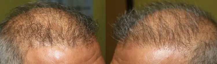 Ein schlechtes Ergebnis, das nach einer Haartransplantation auftritt.