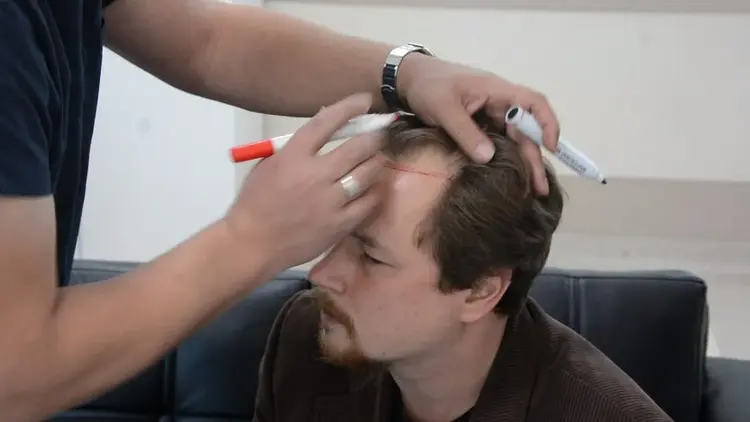Diseño de la línea de cabello antes de un trasplante capilar.
