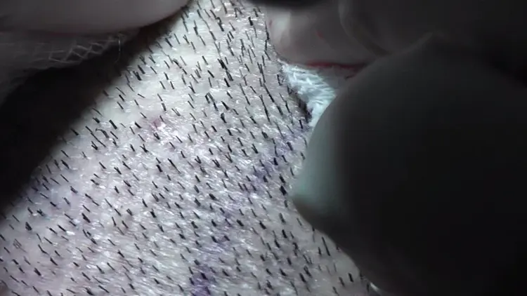 Bei der Haartransplantation wird die Entnahme der Grafts mittels FUE-Methode durchgeführt.