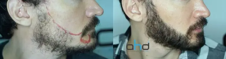 image avant-après d'une greffe de barbe