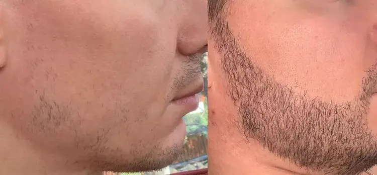 Aspect 4 mois après une greffe de barbe
