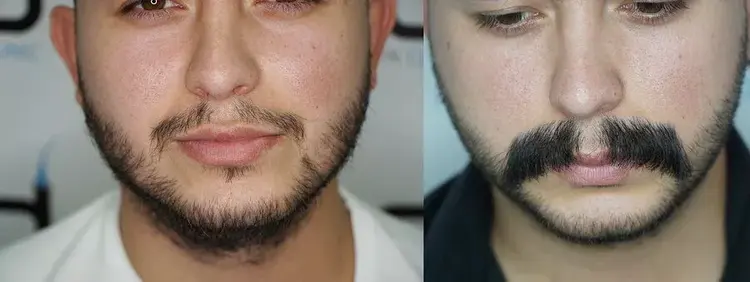greffe de moustache avant-après