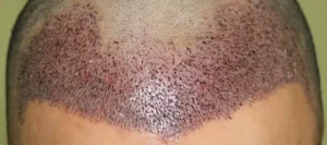 Haartransplantation