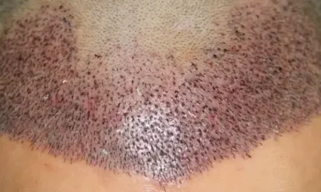 Haartransplantation