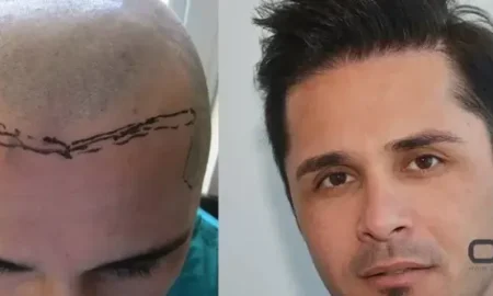 Natürliche Haartransplantation