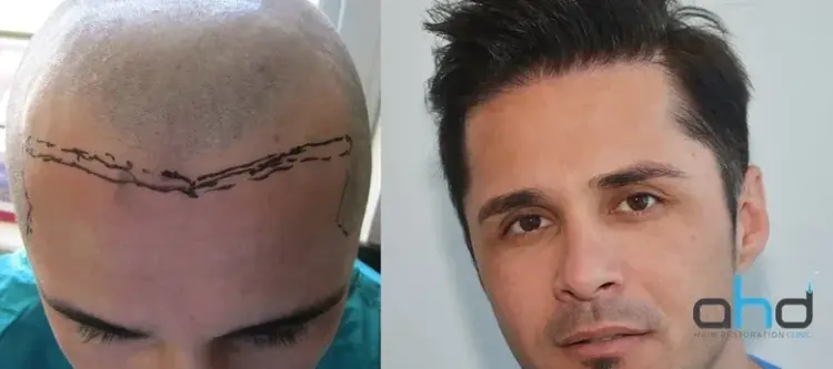 Natürliche Haartransplantation