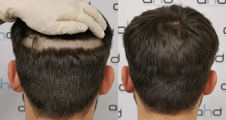 Nicht-rasierte-Haartransplantation