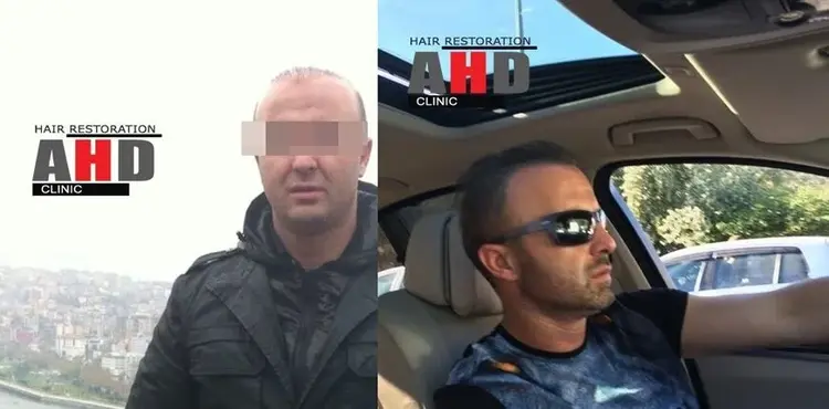 Zweifelhafte Haartransplantation und Korrekturoperation Ergebnisse