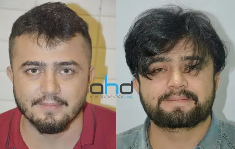 Le patient qui a subi une greffe de barbe et de moustache a obtenu d'excellents résultats