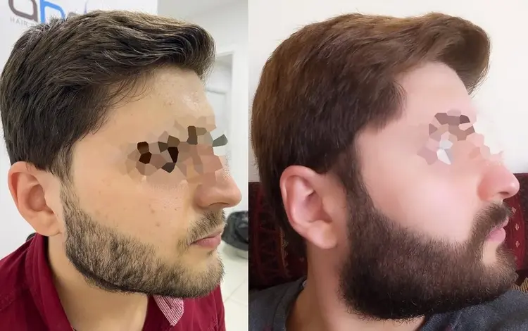 Résultats d'une greffe de barbe épaississante