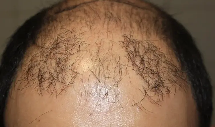 Das schlechte Ergebnis einer verpfuschten Haartransplantation