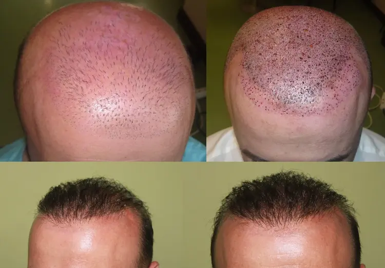 Wie behebt man ein schlechtes Ergebnis bei einer Haartransplantation? Die Antwort liegt im Bild.