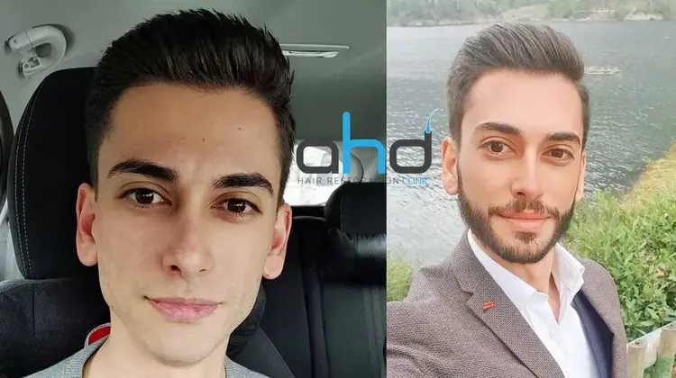 L'apparence de l'homme qui se rase la barbe 6 mois après une greffe