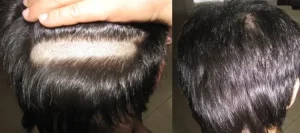 Unrasierte-Haartransplantation