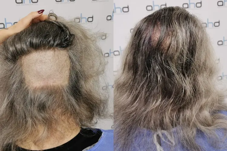 Unrasierte-Haartransplantation-fue