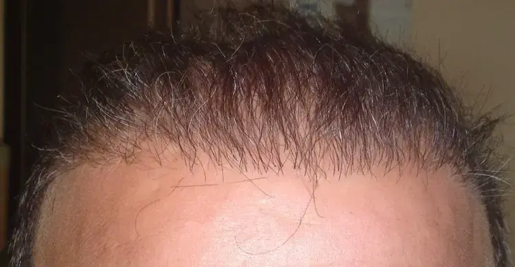 Eine Haarverpflanzung zu sehen, die zu einem Fehlschlag geführt hat