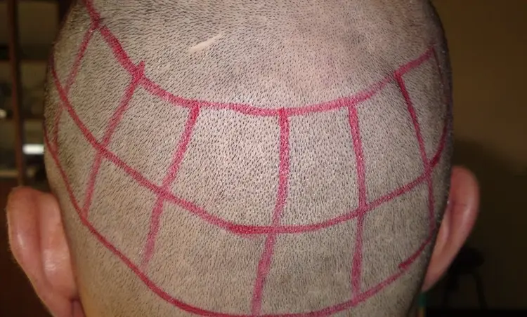 Zona donante para trasplante de cabello (cabello de la parte posterior de la cabeza).