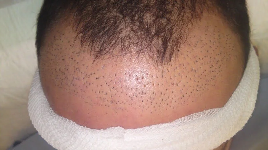 bad hair plugs