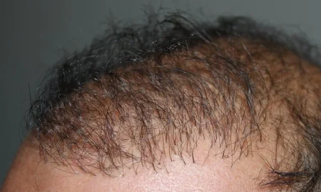 bad hair transplant