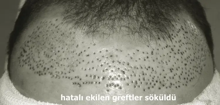 saç ekiminde yanlış ekilen greftleri çıkarmak gereklidir.