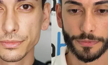 beard transplant turkey