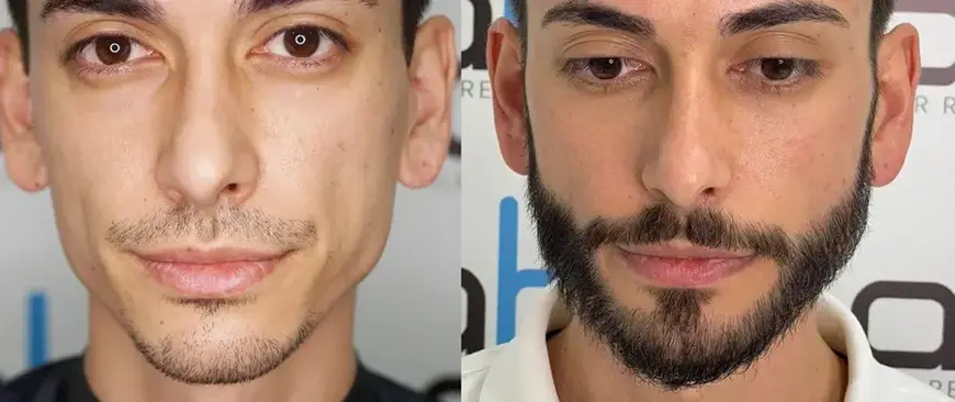 beard transplant turkey