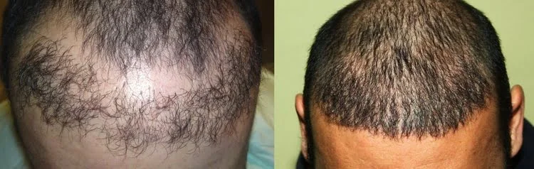 Une chevelure d'aspect naturel après une intervention corrective suite à une greffe de cheveux manquée.