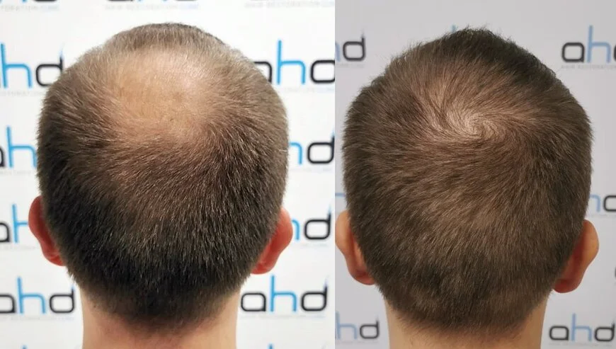 crown hair transplant before after