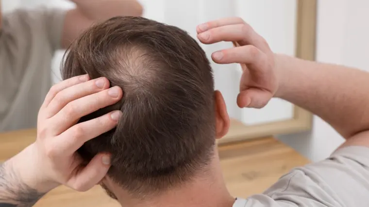 crown hair transplant