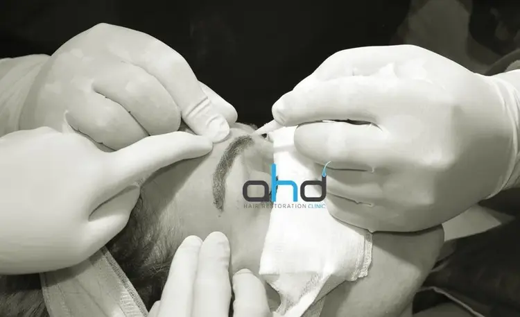 Transplante de sobrancelha com o método DHI