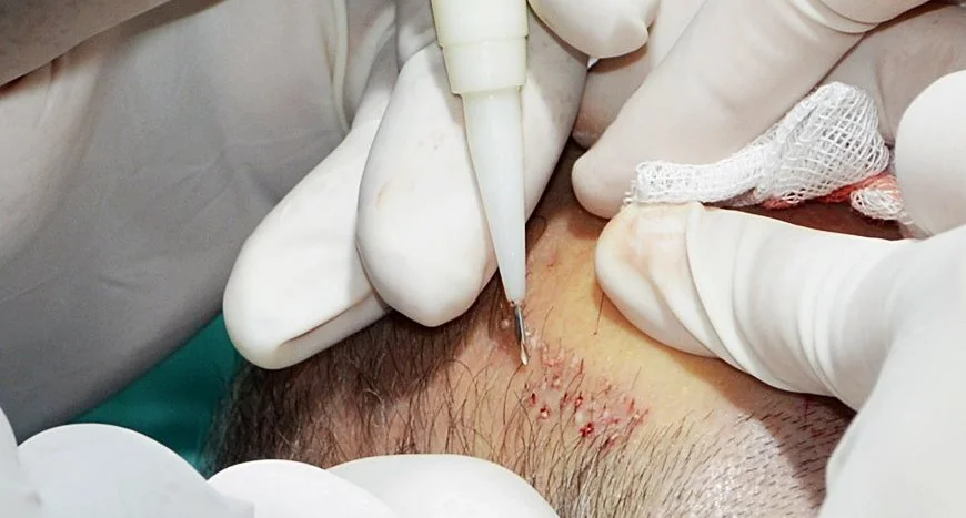 direct hair transplant