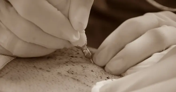 extraindo pelos do corpo para transplante capilar