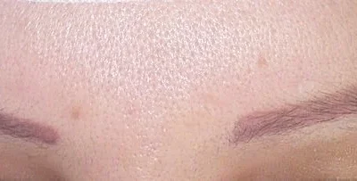 eyebrow hair transplant