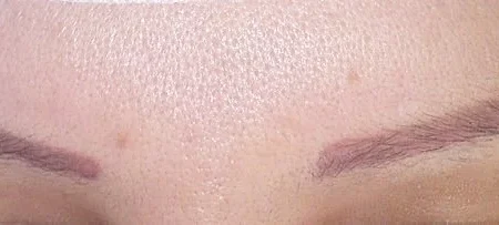 eyebrow transplant