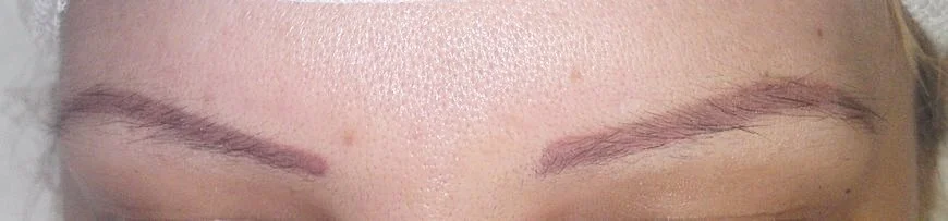 eyebrow transplant
