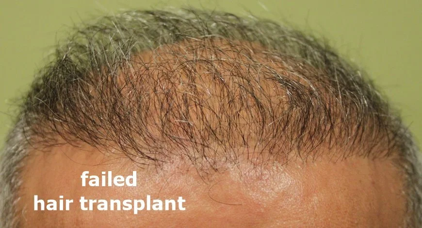 hair transplant fail