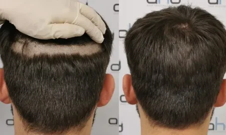 fue haartransplantatie zonder scheren