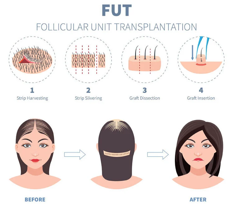 Haartransplantatie met de FUT-techniek