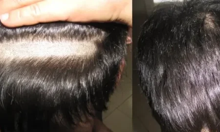 greffe de cheveux sans rasage