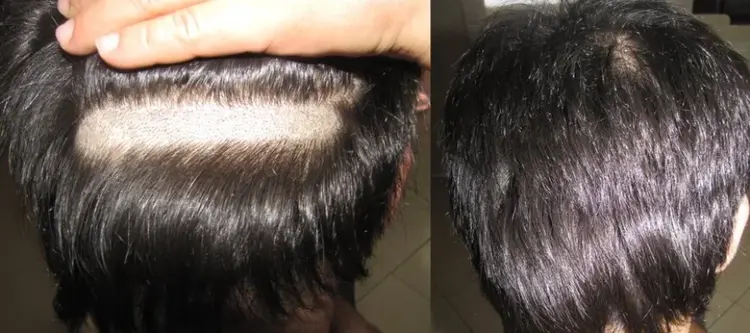 greffe de cheveux sans rasage