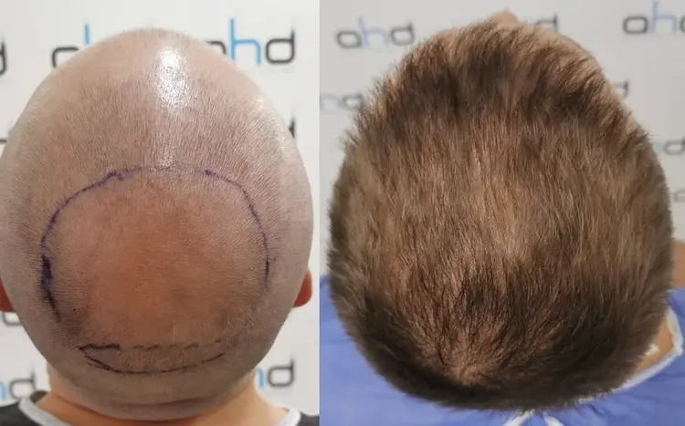 greffe de cheveux vertex