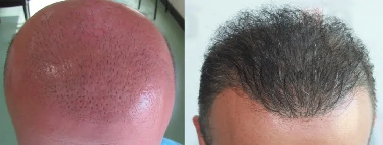 Unsightly appearance due to a failed hair transplant - natural results after correction