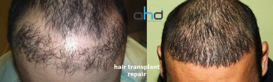 hair transplant repair