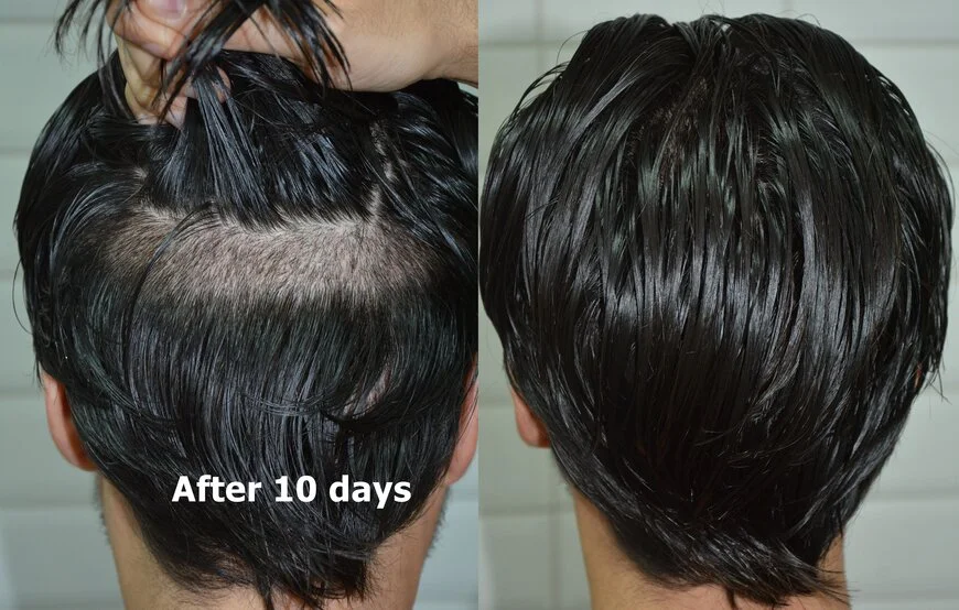 hair transplant without shaving
